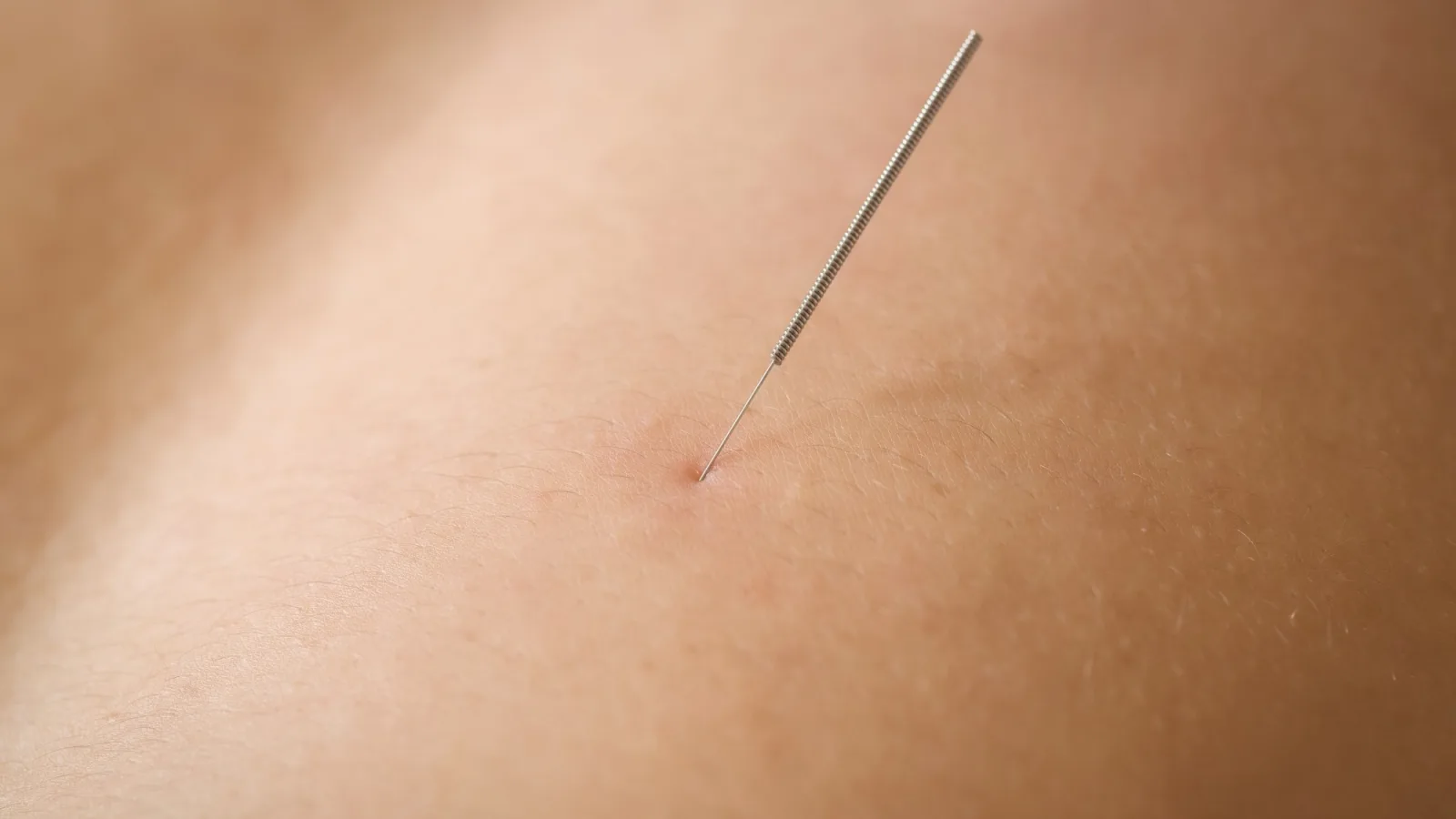 Aiguille d'acupuncture sur la peau